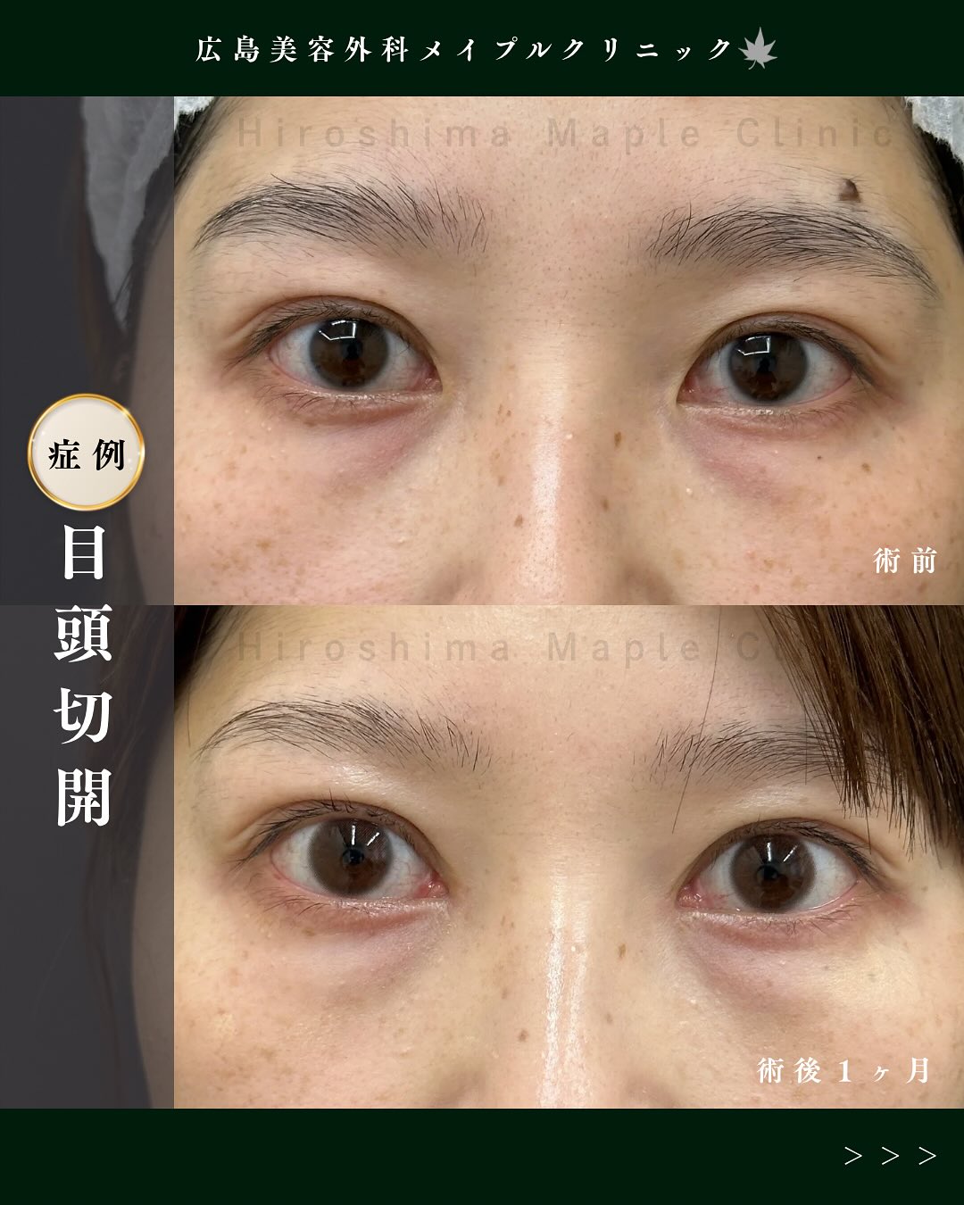 メイプル式目頭切開のメイン画像