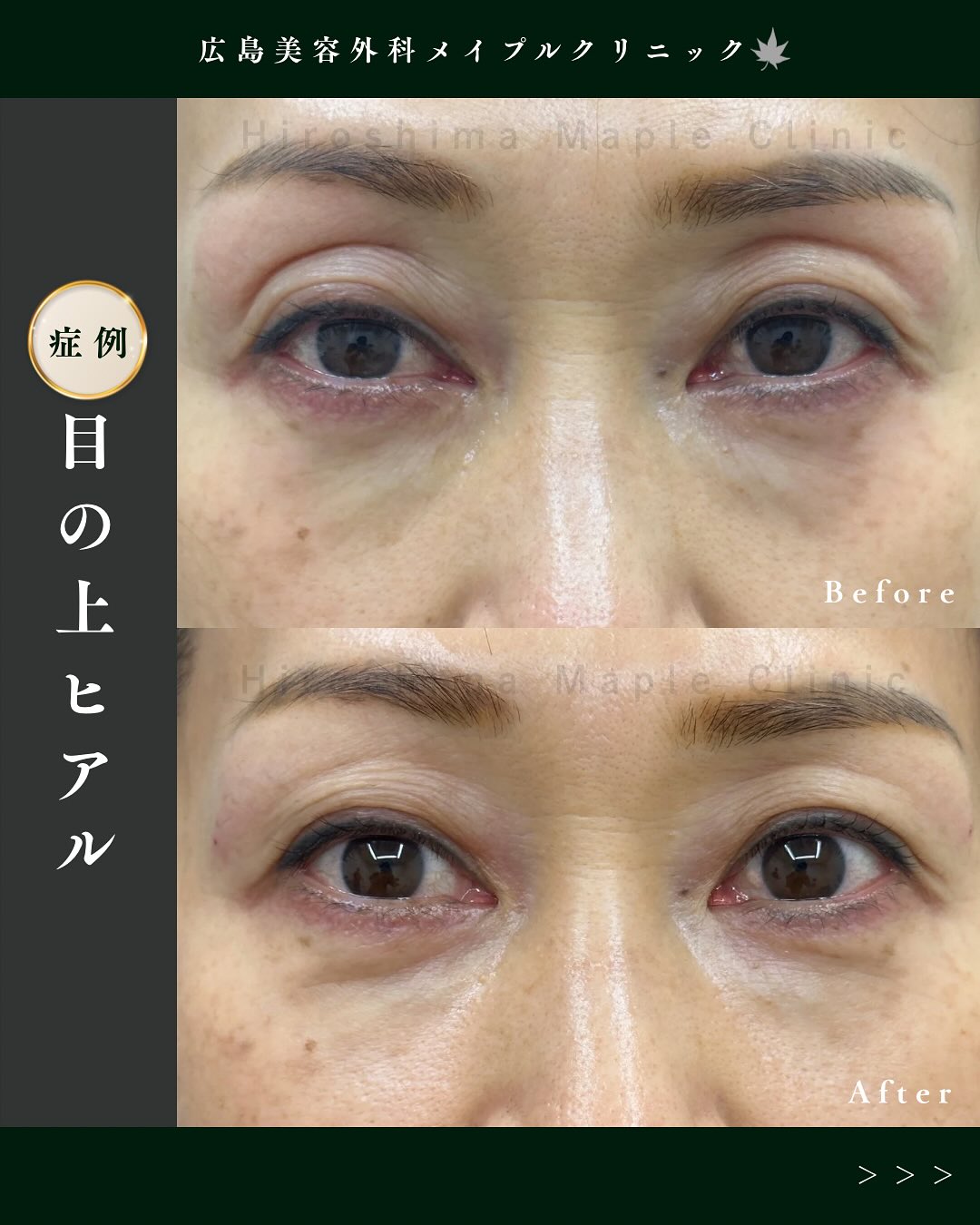 目の上のヒアルロン酸症例のメイン画像