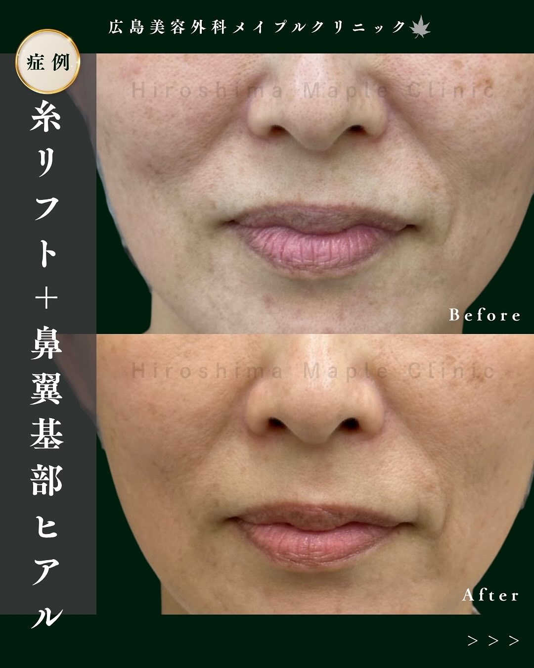 糸リフトと鼻翼基部ヒアルロン酸の症例のメイン画像