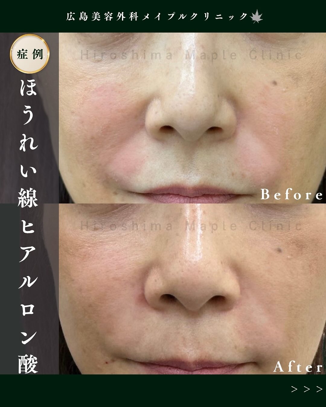 ヒアルロン酸で若返り治療のメイン画像