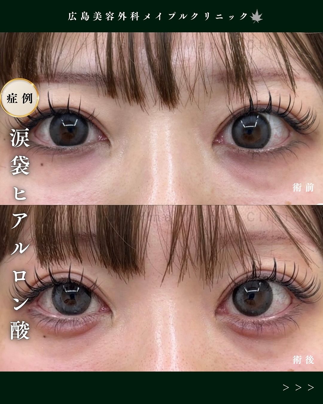 ヒアルロン酸注入