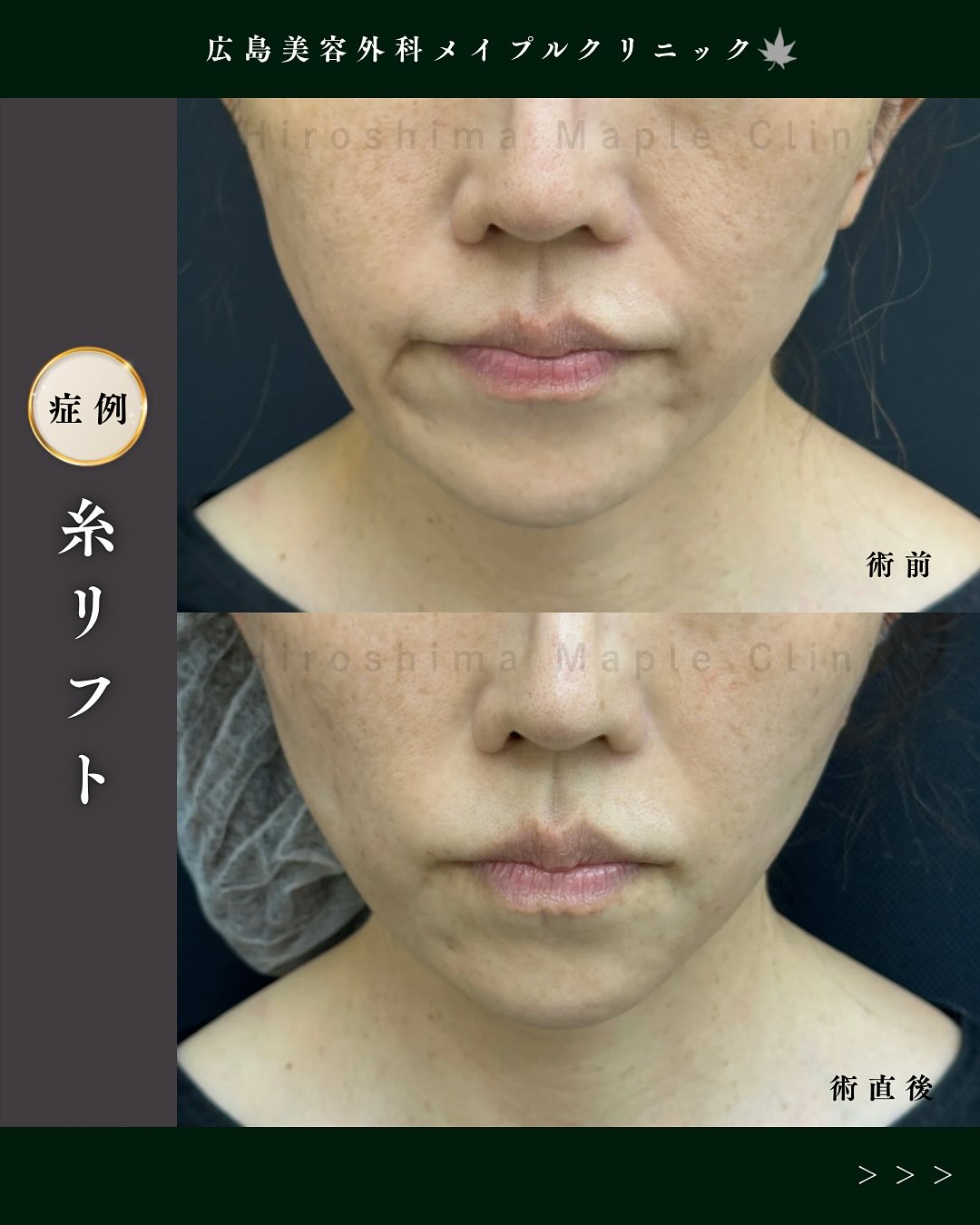 ダブルコグリフト12本のメイン画像