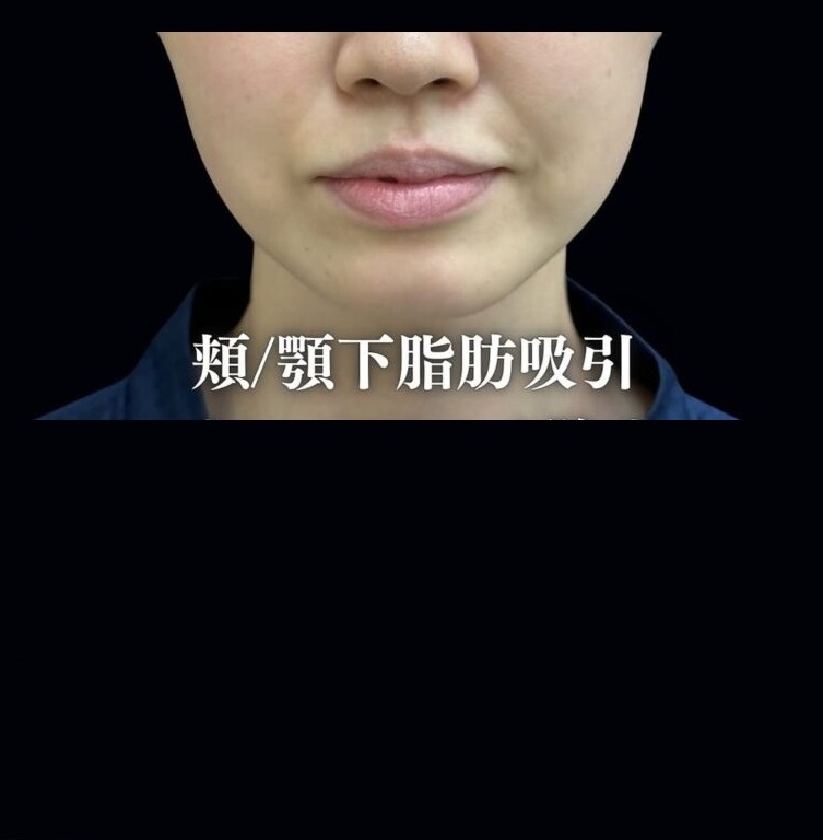 脂肪吸引と糸リフトの症例のメイン画像