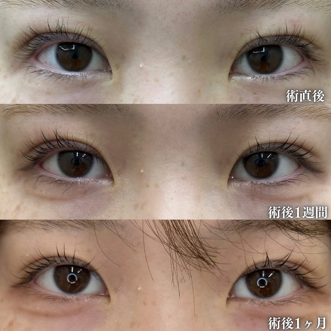 埋没法症例