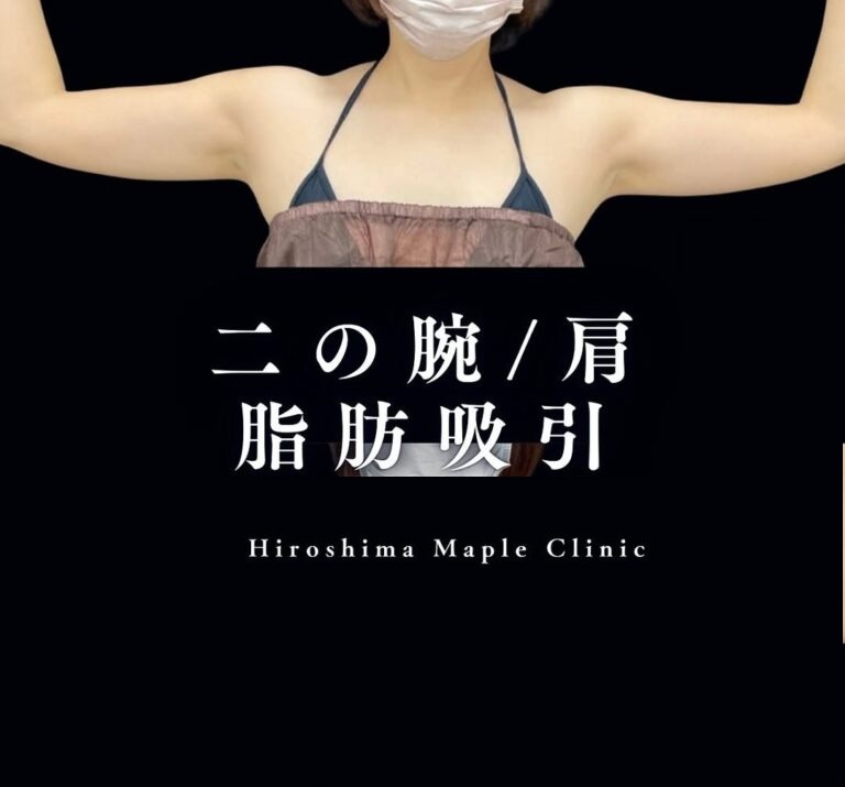 二の腕脂肪吸引のメイン画像