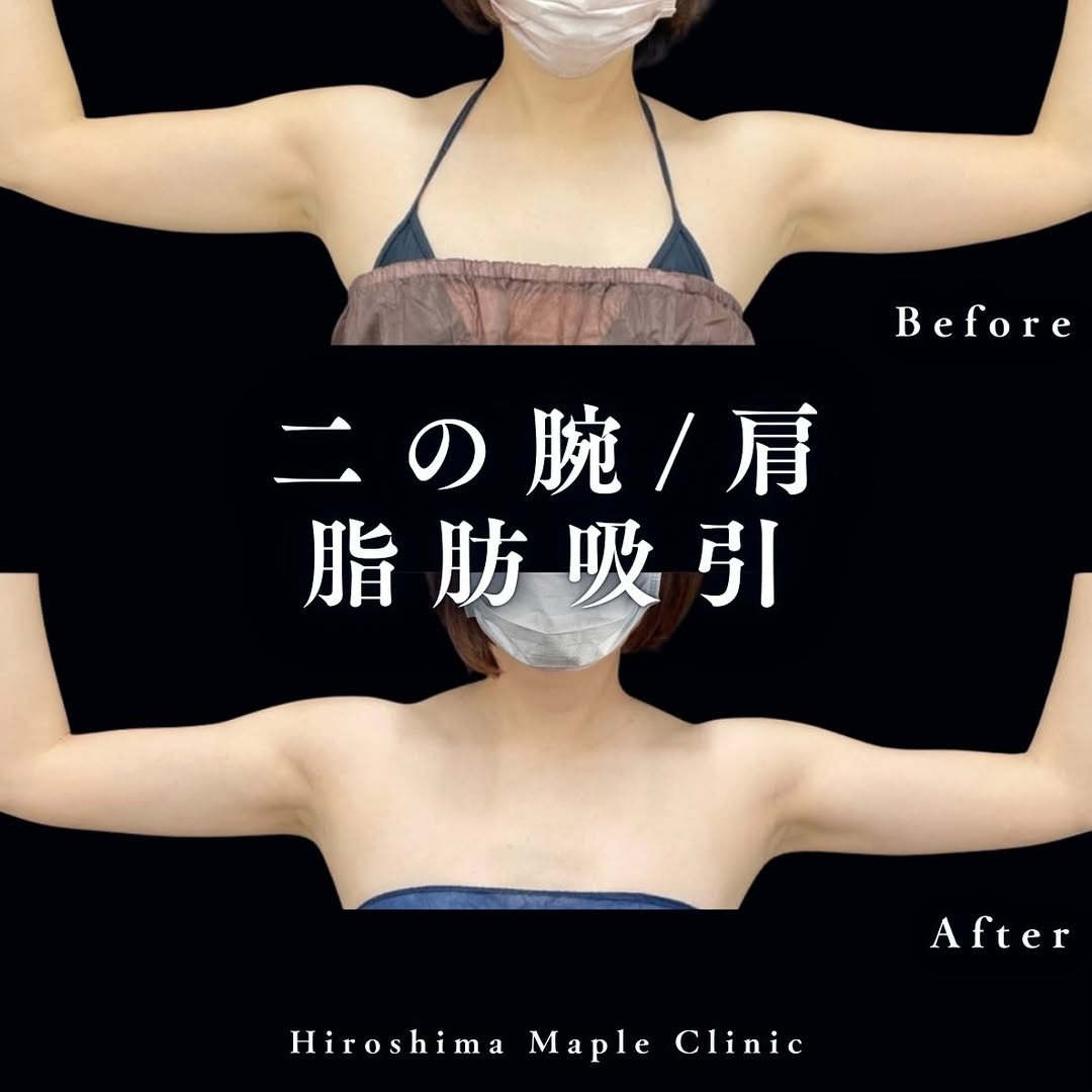 脂肪吸引