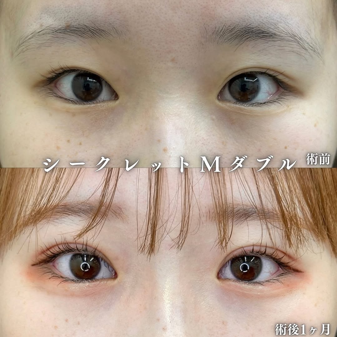 二重整形埋没法症例のメイン画像