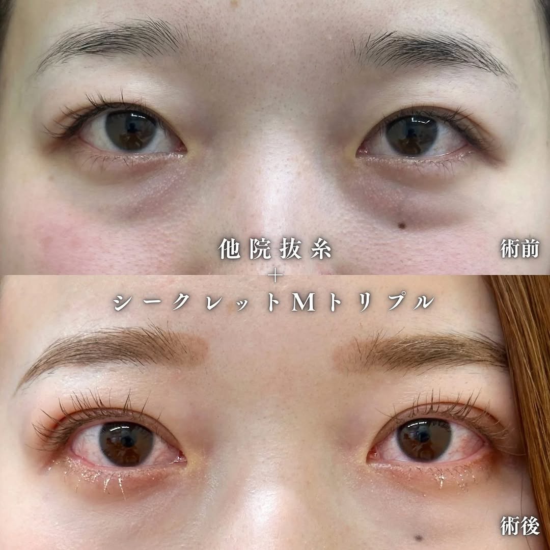 抜糸→シークレットMトリプルのメイン画像