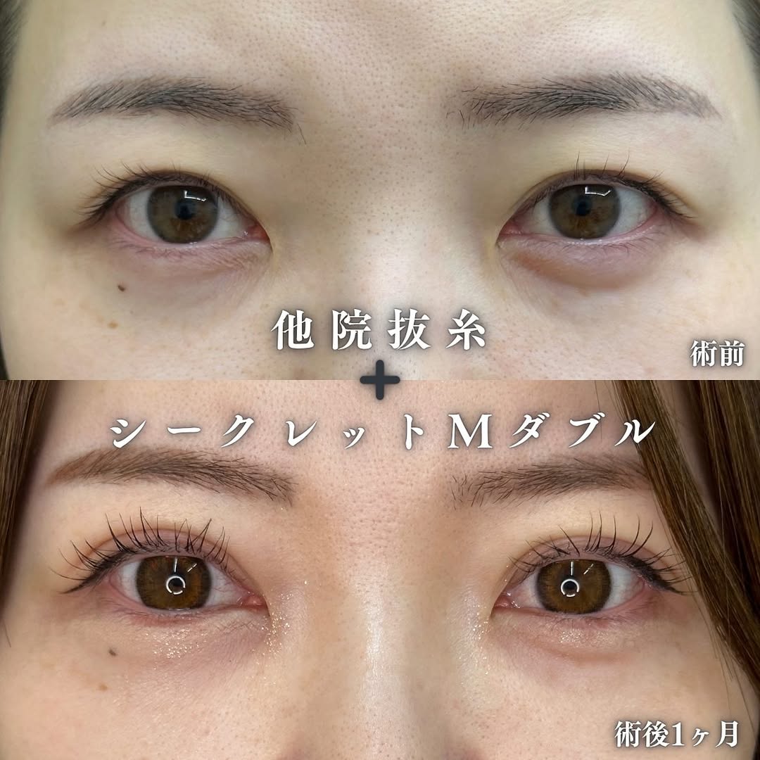 抜糸から埋没法のメイン画像