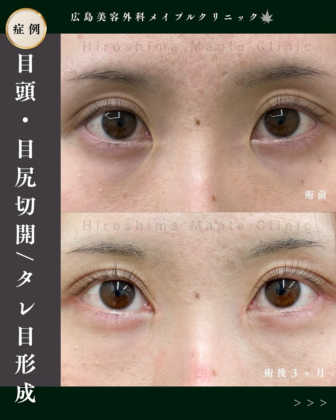 タレ目形成症例 - 広島美容外科メイプルクリニック