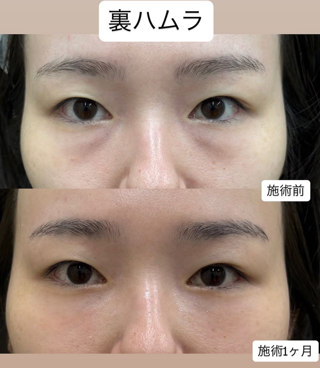 クマ取り治療の症例のメイン画像