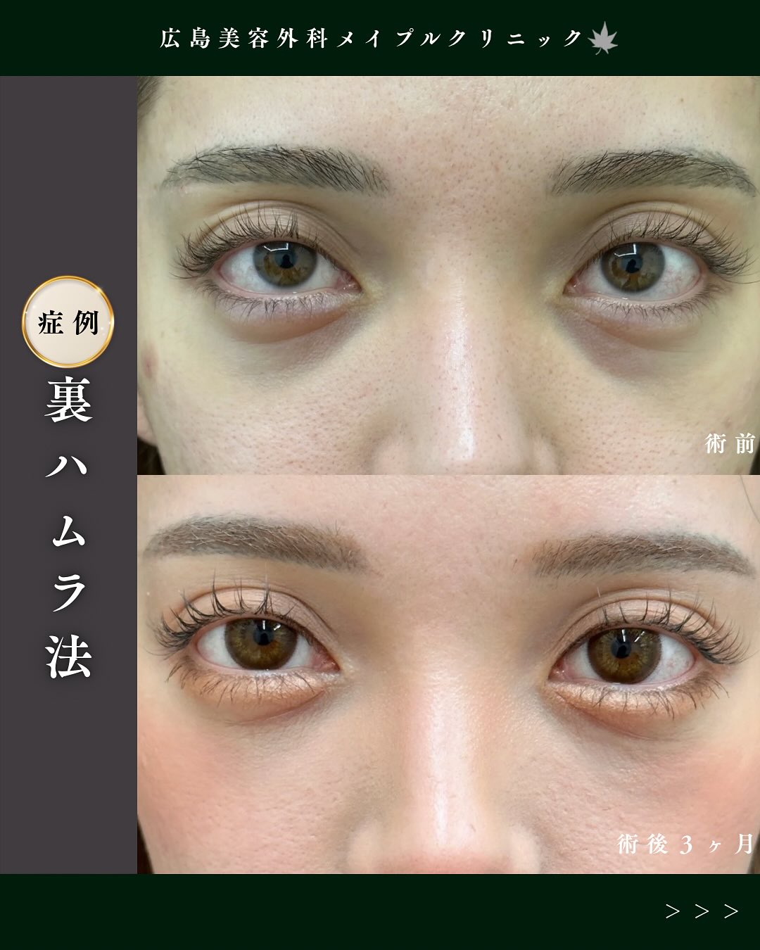 クマ取り治療の症例のメイン画像