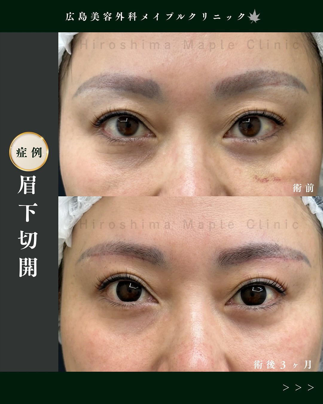 眉下切開