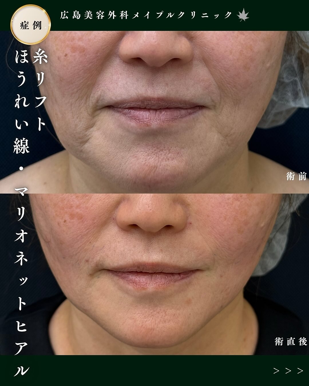 糸リフト&ヒアルロン酸注入のメイン画像