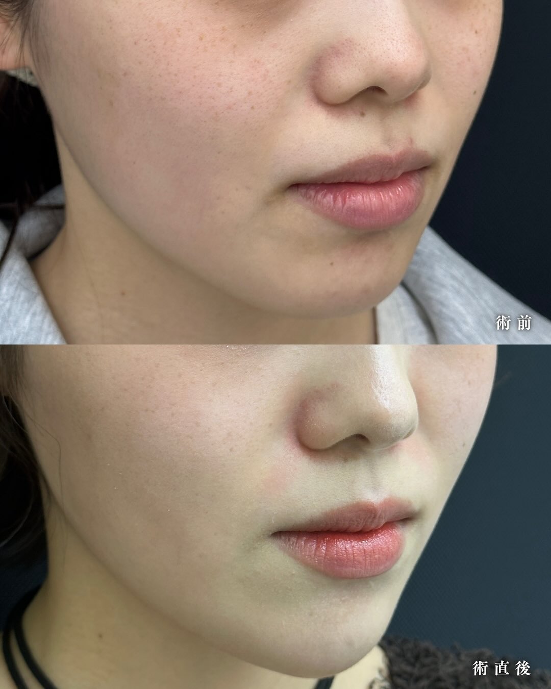 ヒアルロン酸注入