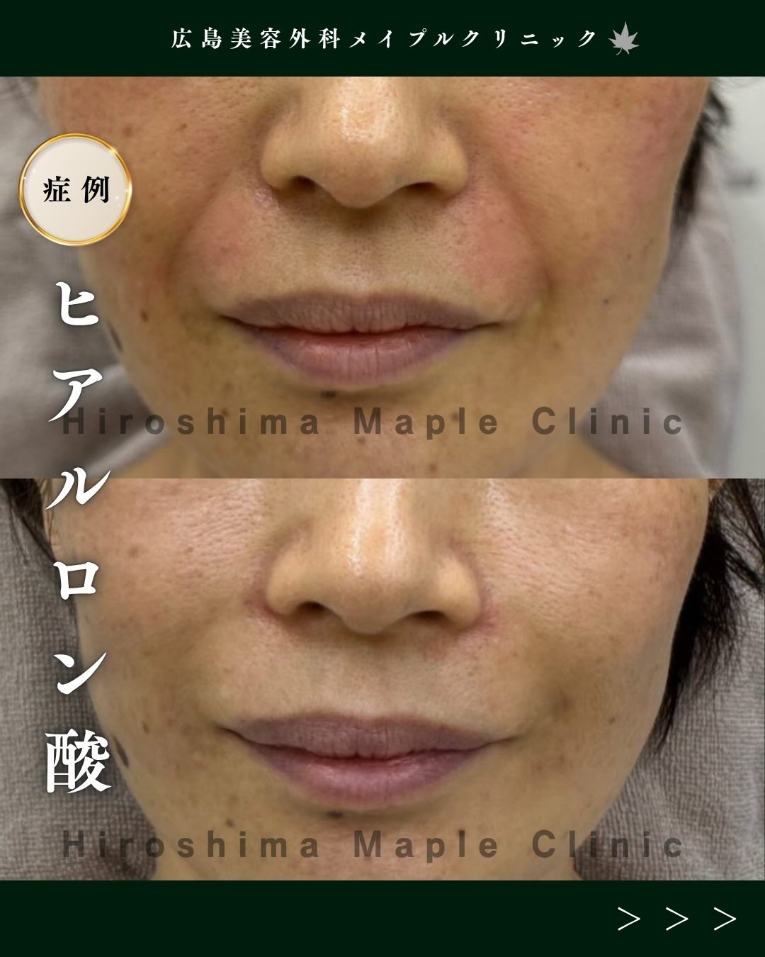 ヒアルロン酸注入は広島美容外科メイプルクリニック へ