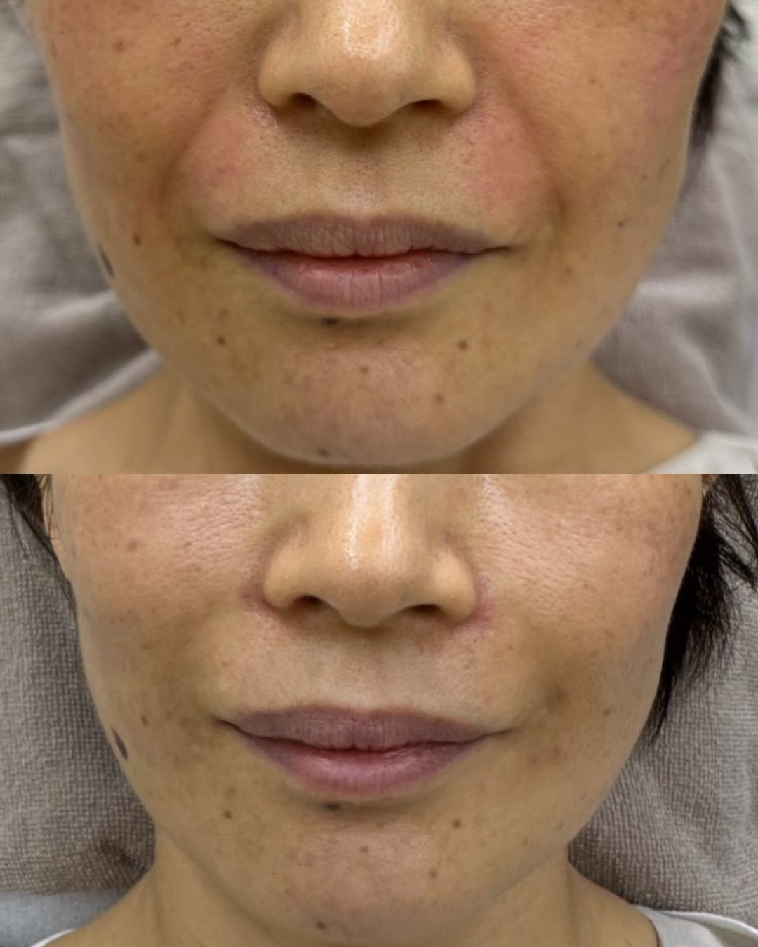 ヒアルロン酸注入症例