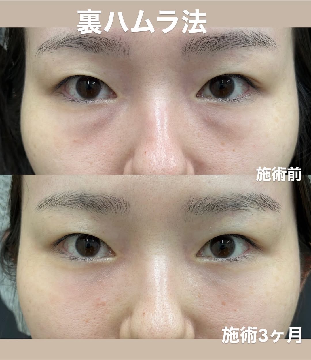 クマ取り治療による若返りのメイン画像