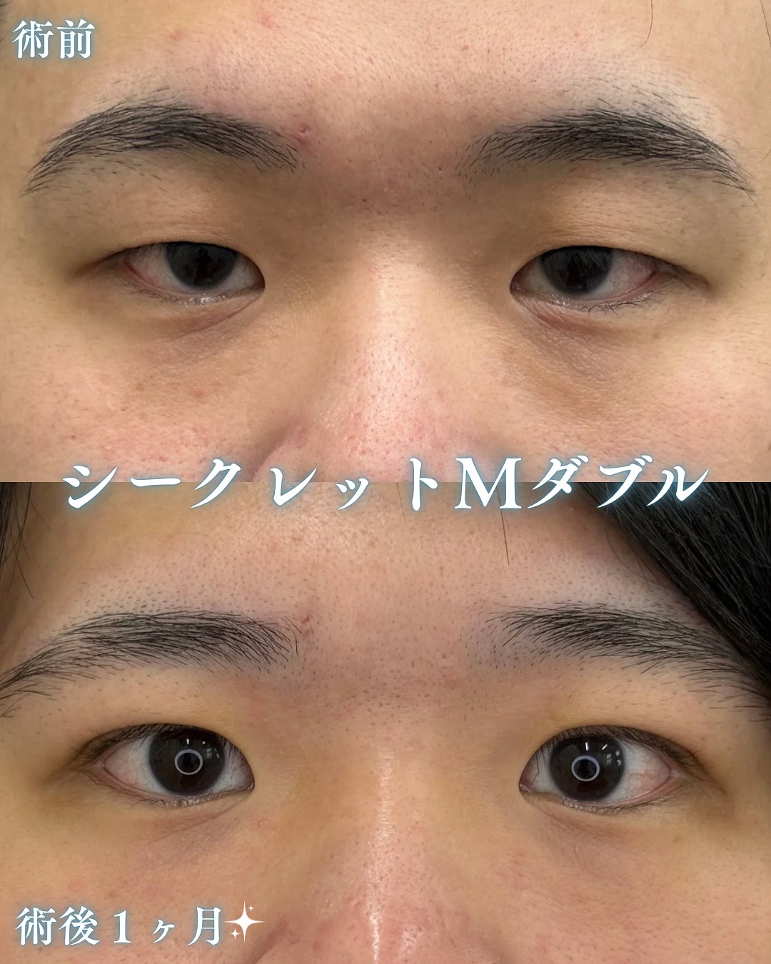 男性の二重整形のメイン画像