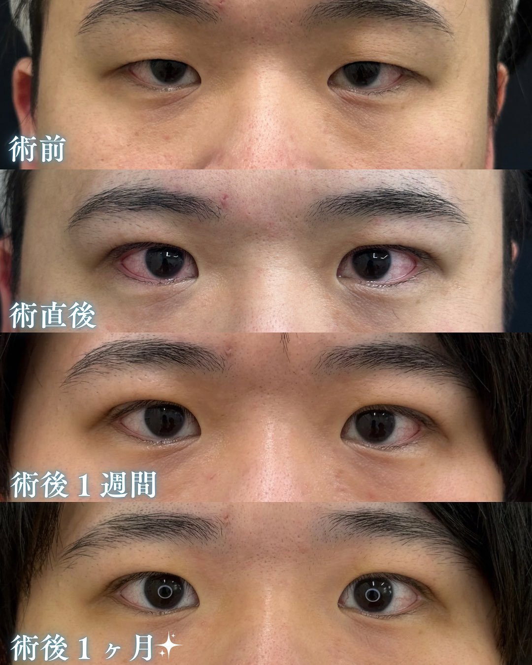 メンズ二重整形