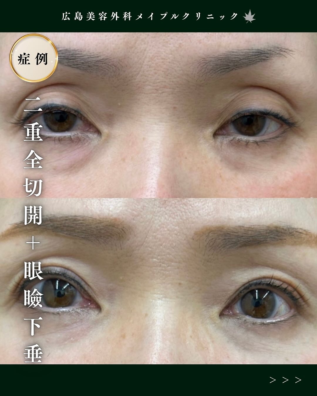 二重全切開＋眼瞼下垂の施術のメイン画像