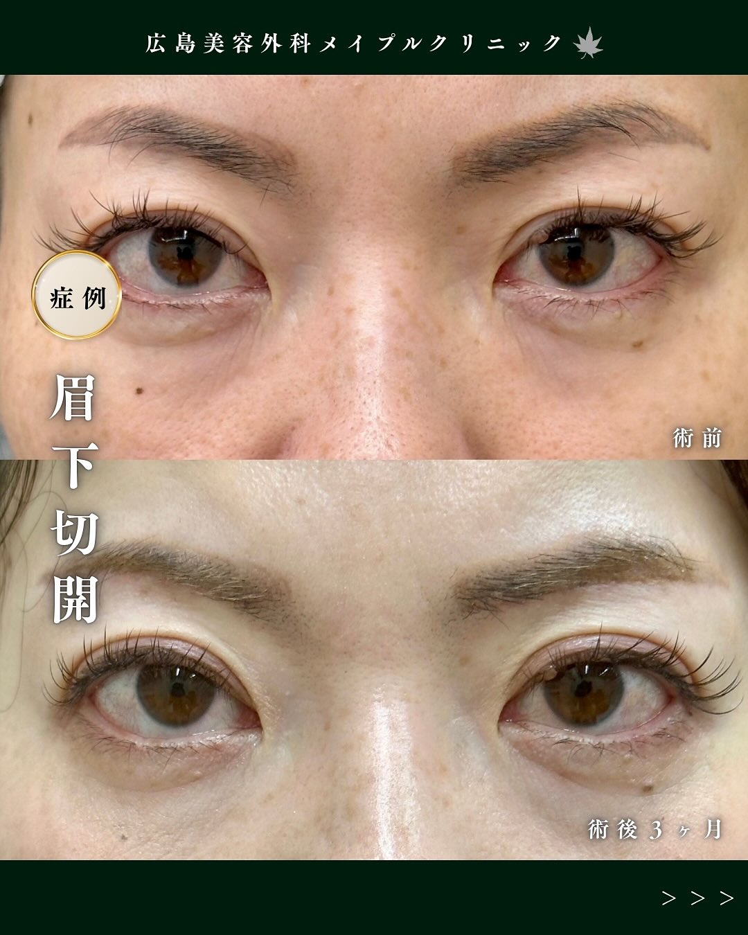 眉下切開で瞼のたるみ取り - 広島美容外科メイプルクリニック