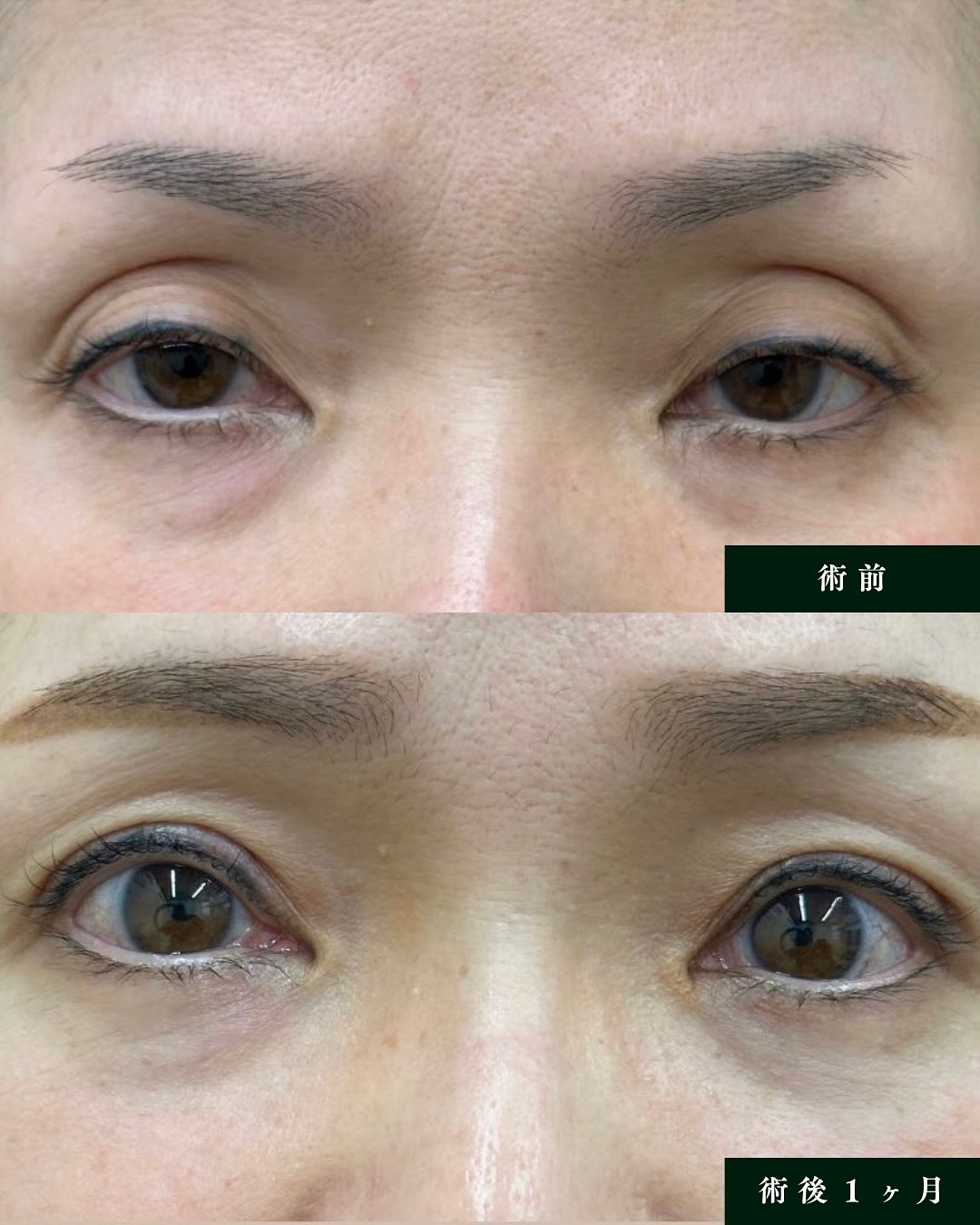 切開・眼瞼下垂