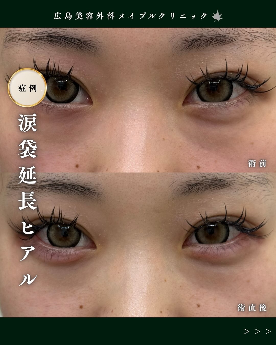 涙袋へヒアルロン酸注入のメイン画像