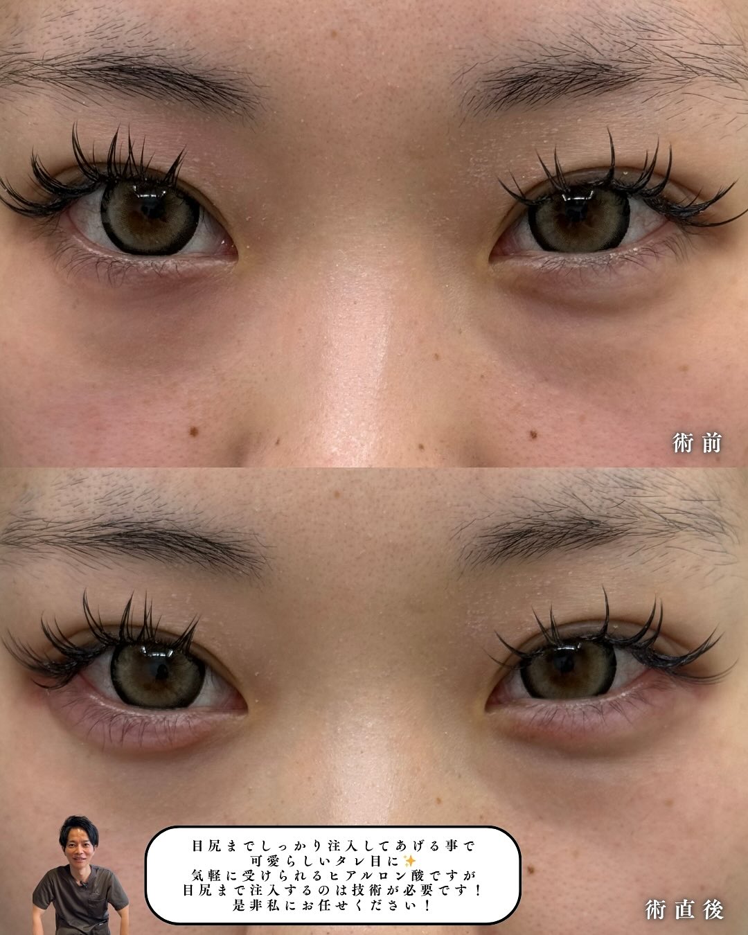 涙袋ヒアルロン酸注入