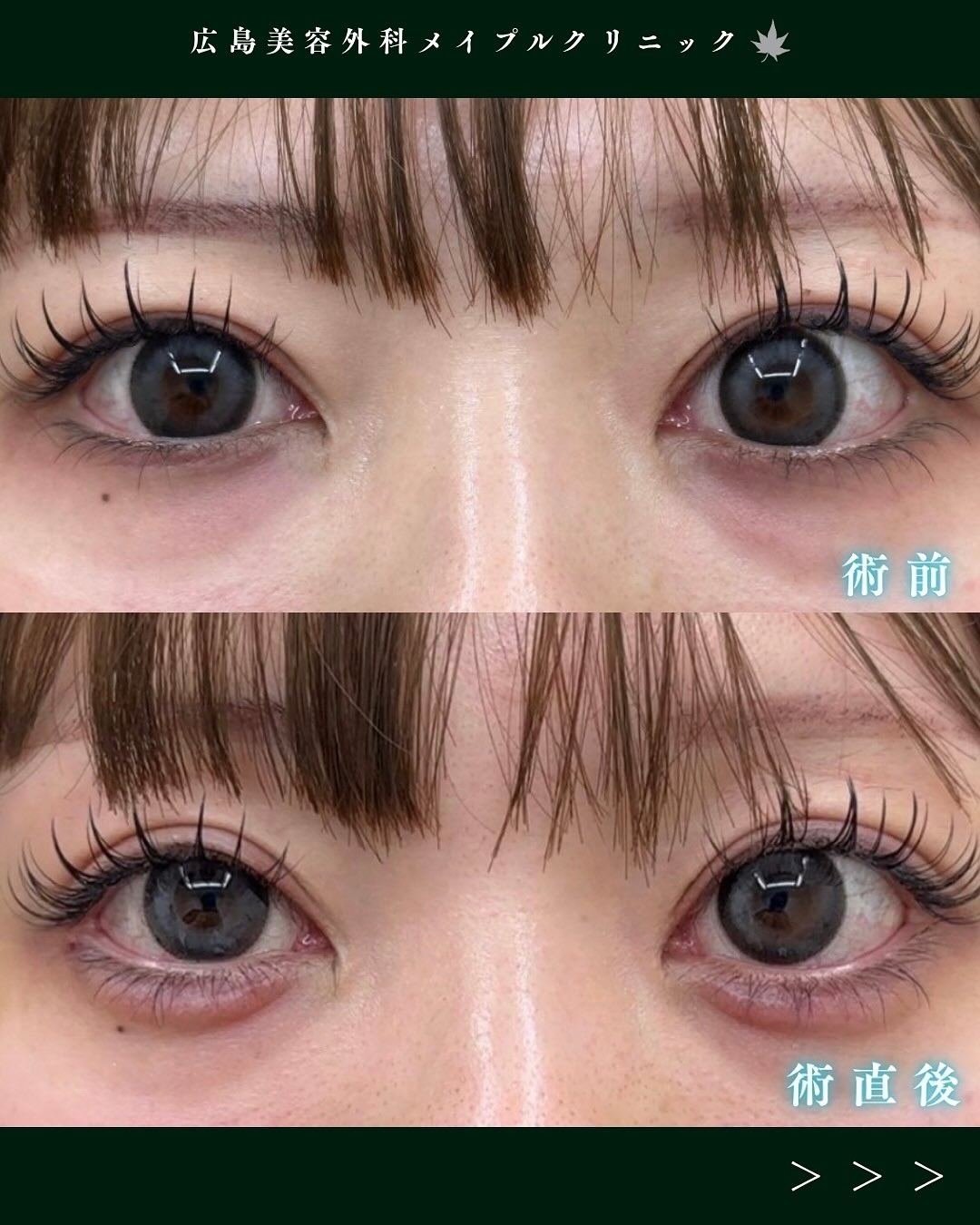 ヒアルロン酸注入症例