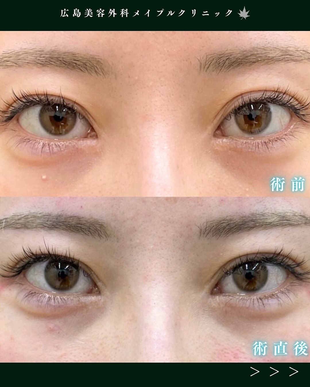 涙袋ヒアルロン酸注入