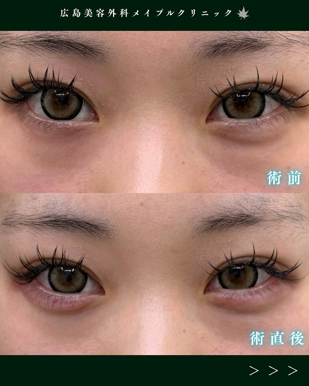 ヒアルロン酸症例