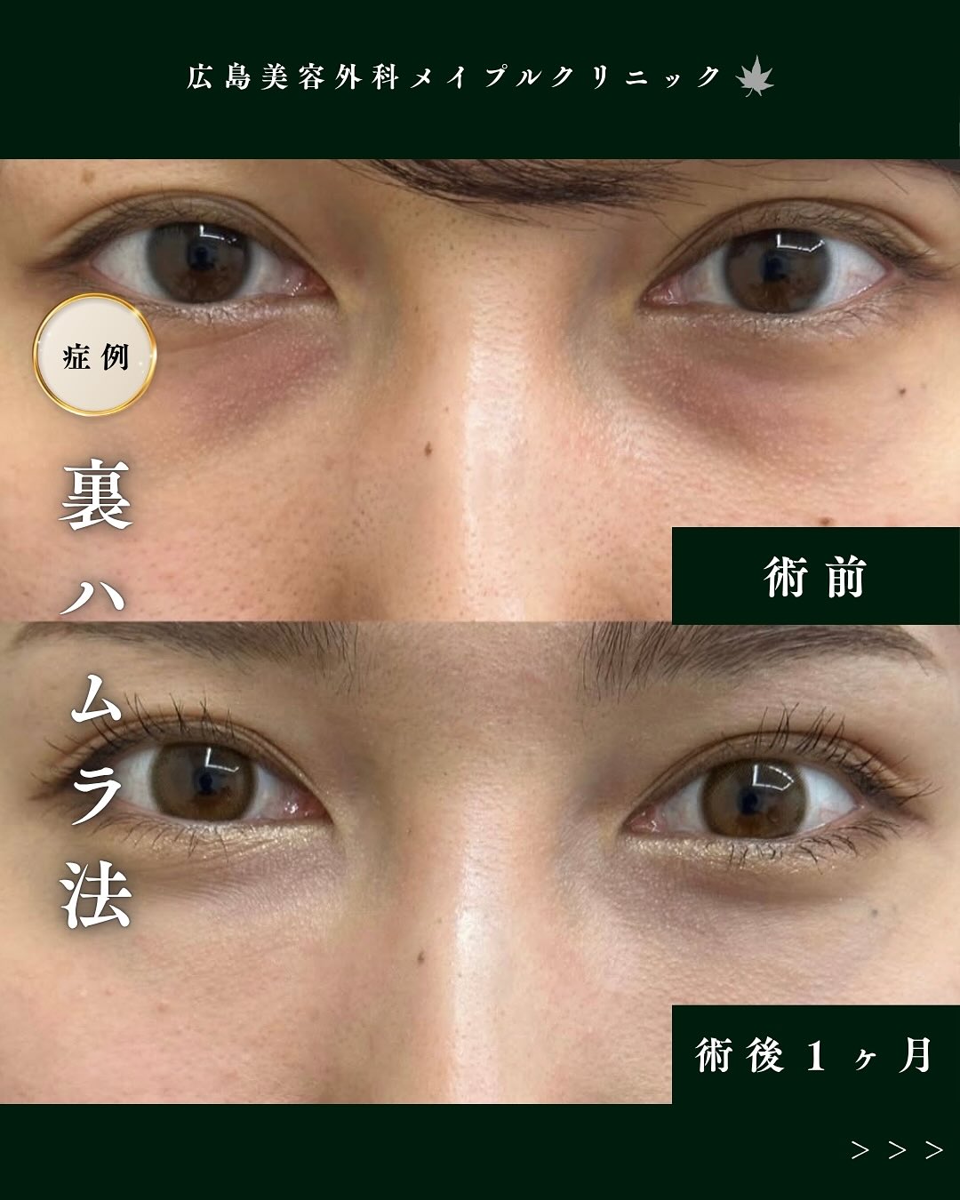 目の下のクマ取り治療のメイン画像