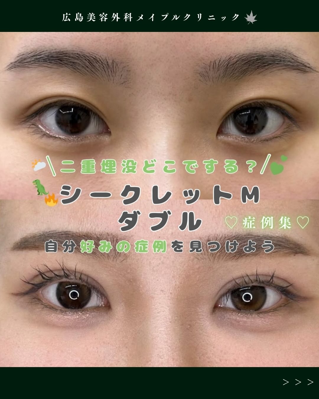 二重整形-埋没法-症例集のメイン画像