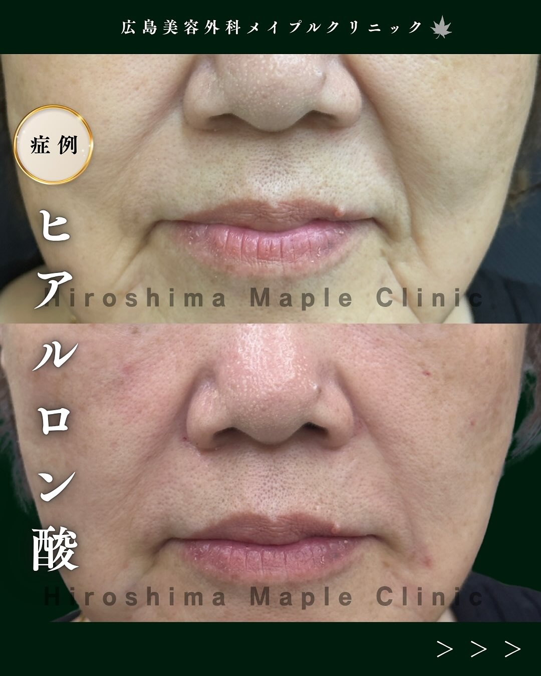 マリオネットラインにヒアルロン酸のメイン画像