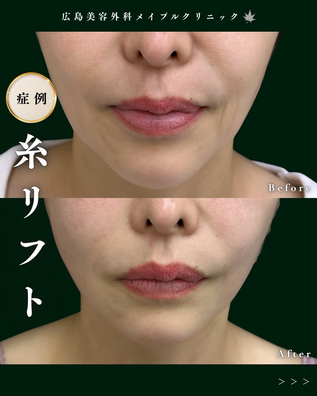 人気急上昇中の糸リフトのメイン画像