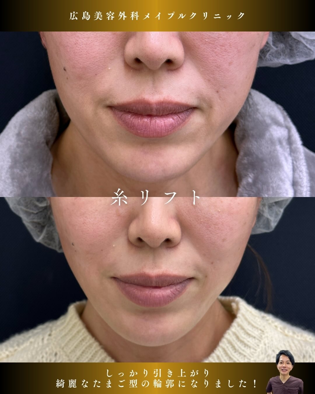 糸リフトで口周りがすっきり！のメイン画像