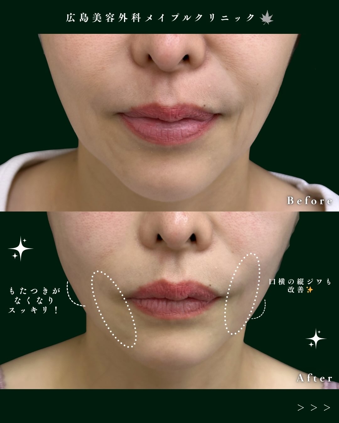 糸リフトの症例