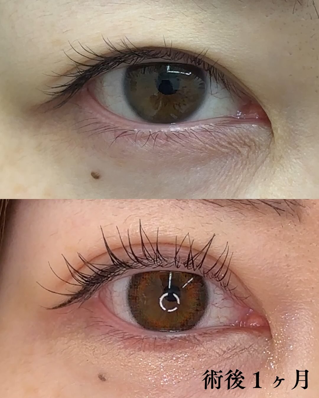 埋没法症例 片目シリーズのメイン画像