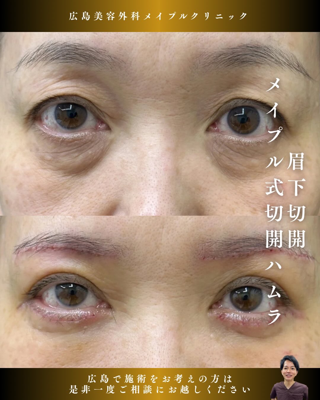 眉下切開＋切開ハムラのメイン画像