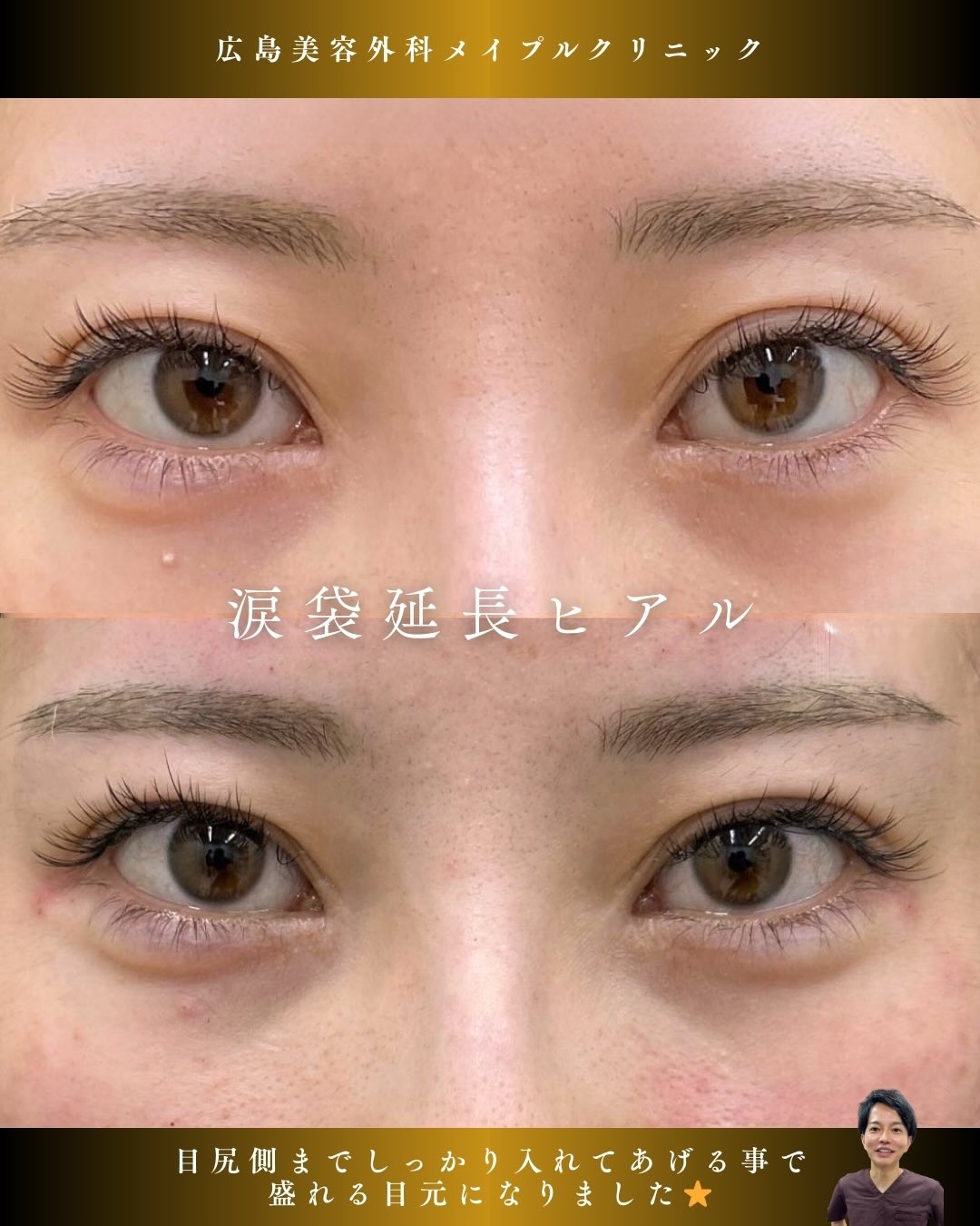 涙袋ヒアルロン酸