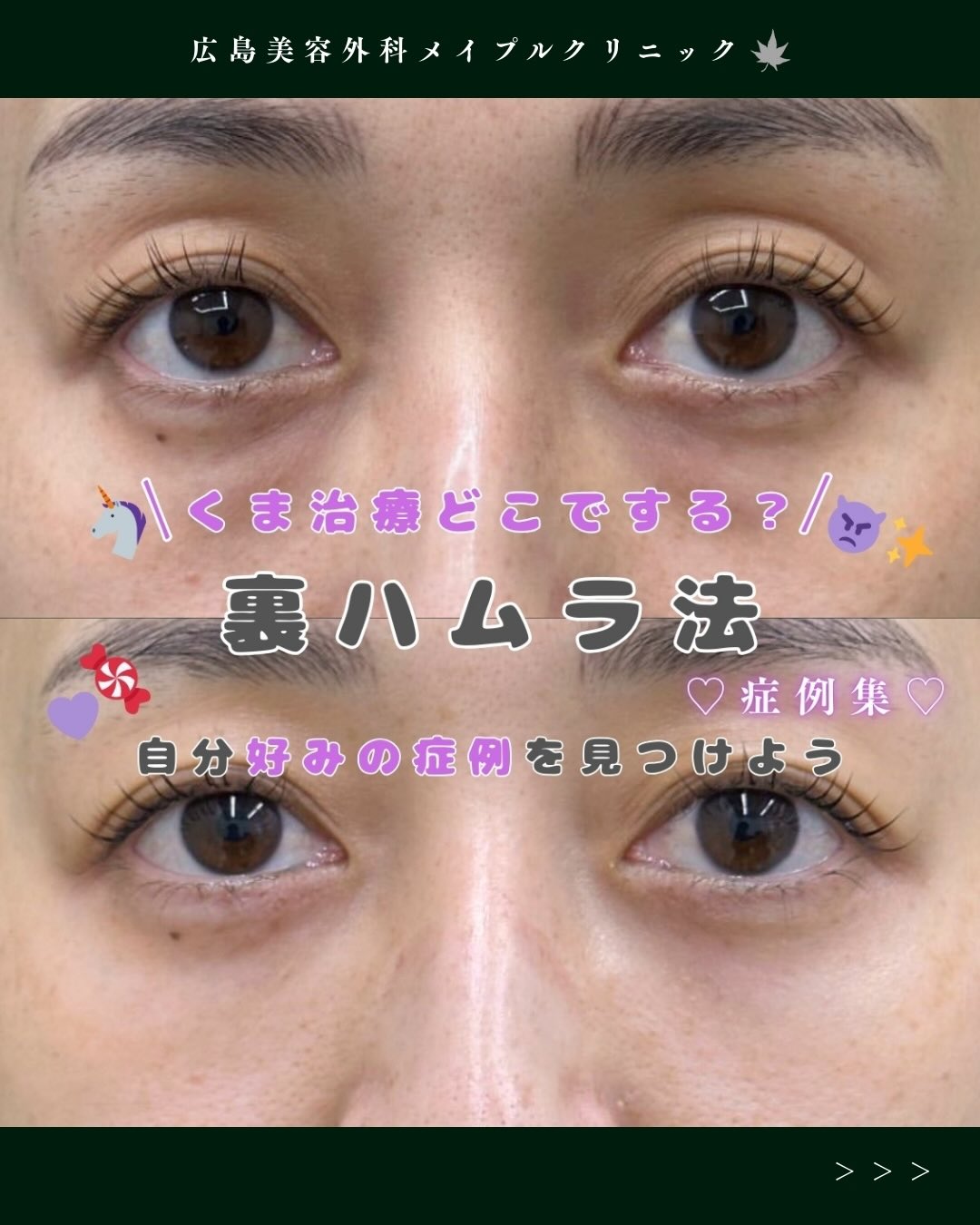 涙袋ができるクマ取りのメイン画像