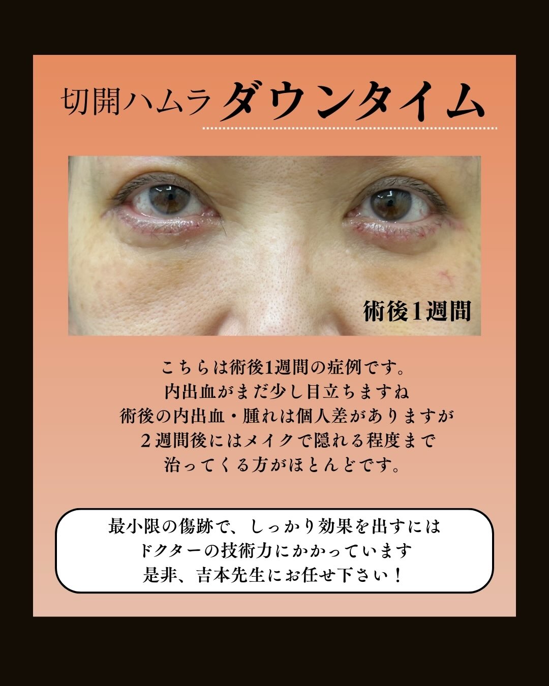 切開ハムラダウンタイム