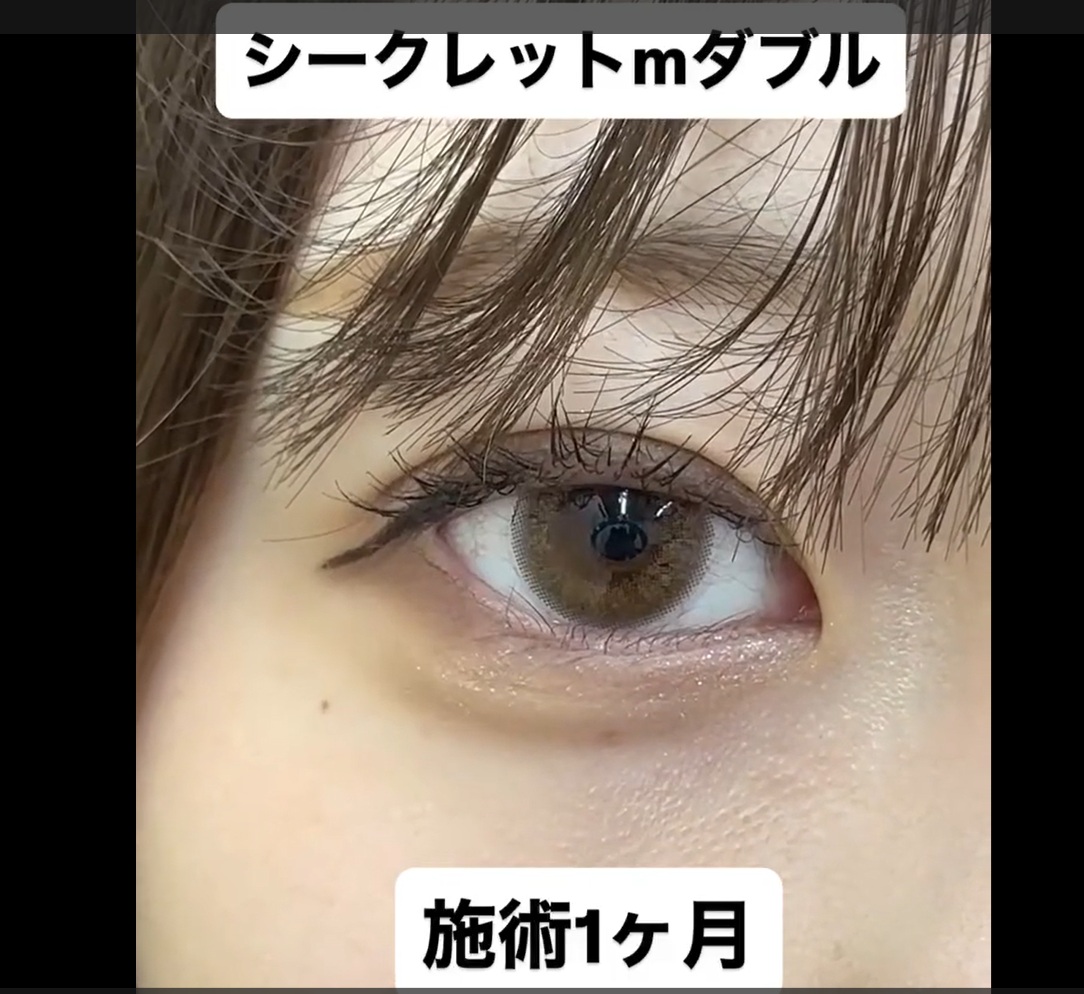 埋没法シークレットMダブル症例のメイン画像