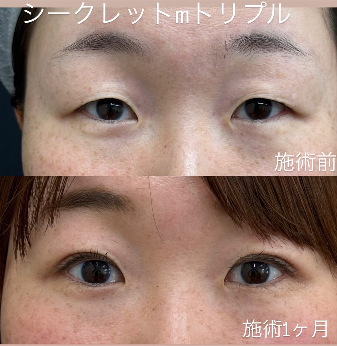 持続性の高い埋没法のメイン画像