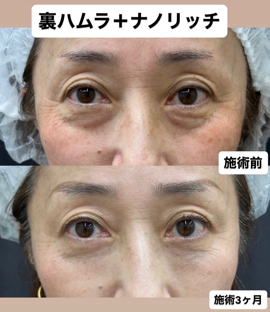 裏ハムラ法＋ナノリッチ脂肪注入によるクマ取りのメイン画像