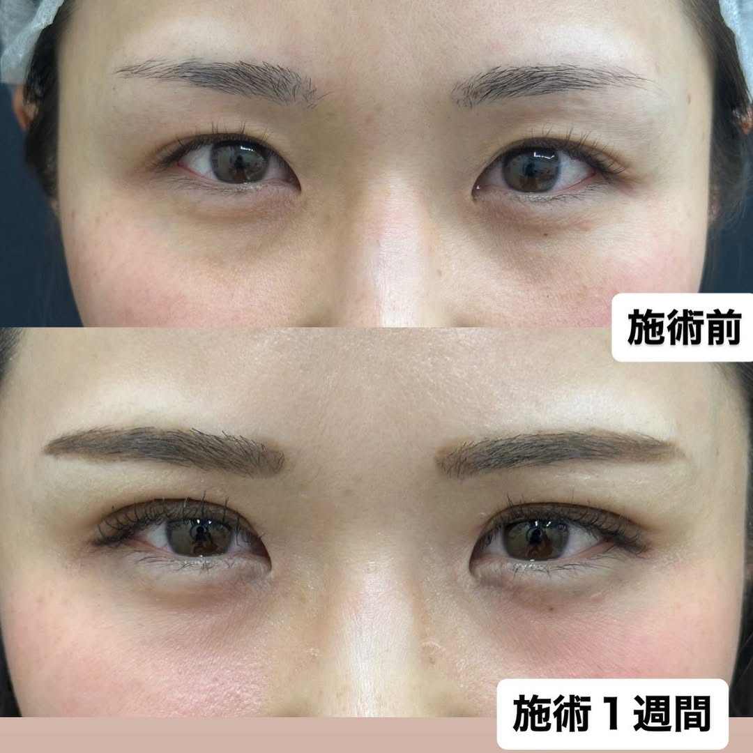 人気の二重埋没法のメイン画像