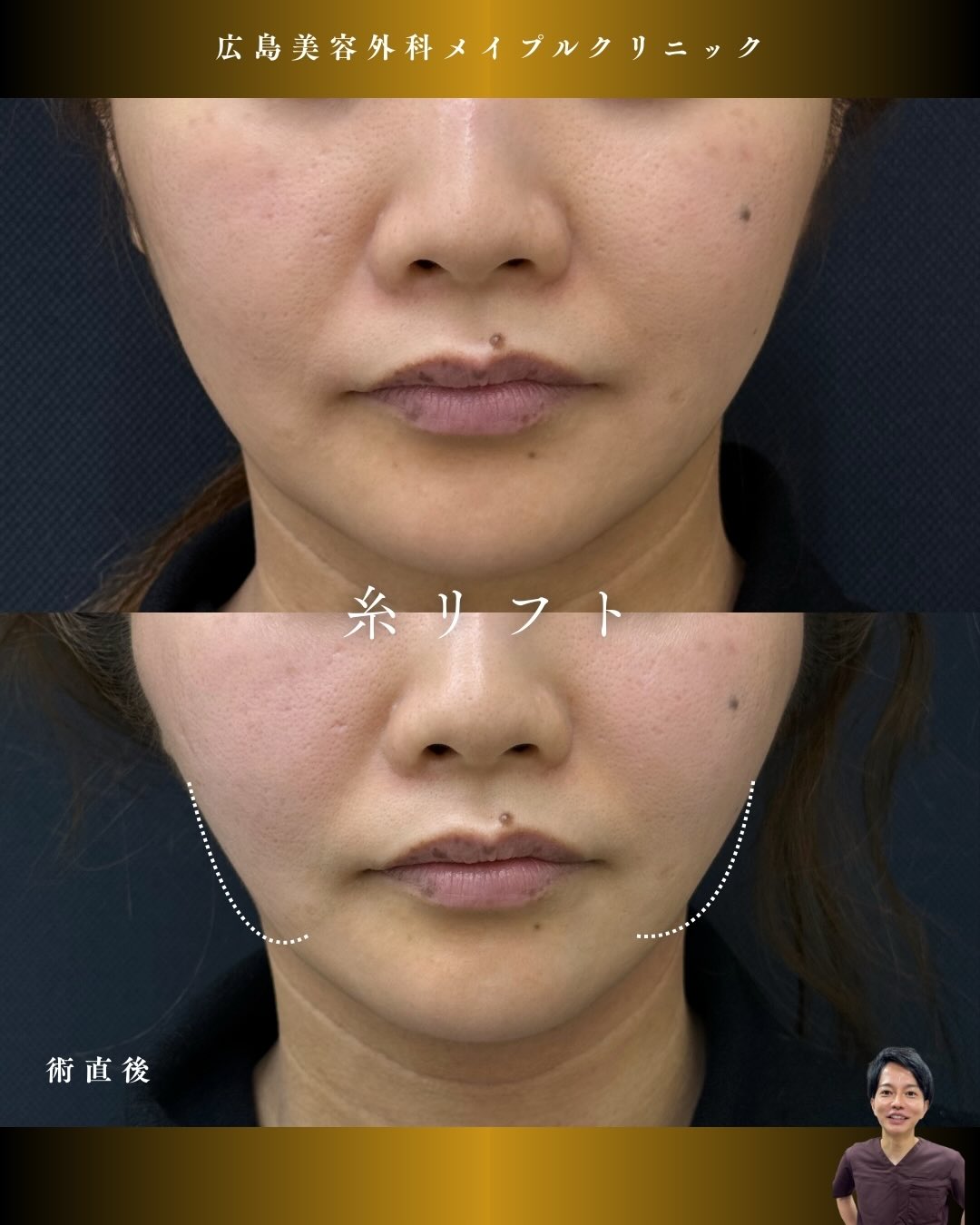 糸リフト＆ほうれい線にヒアルロン酸注入のメイン画像