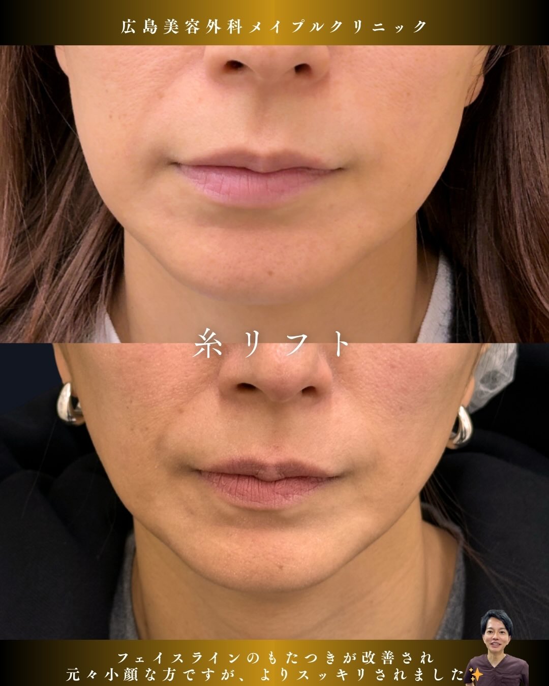 糸リフトでスッキリフェイスラインのメイン画像