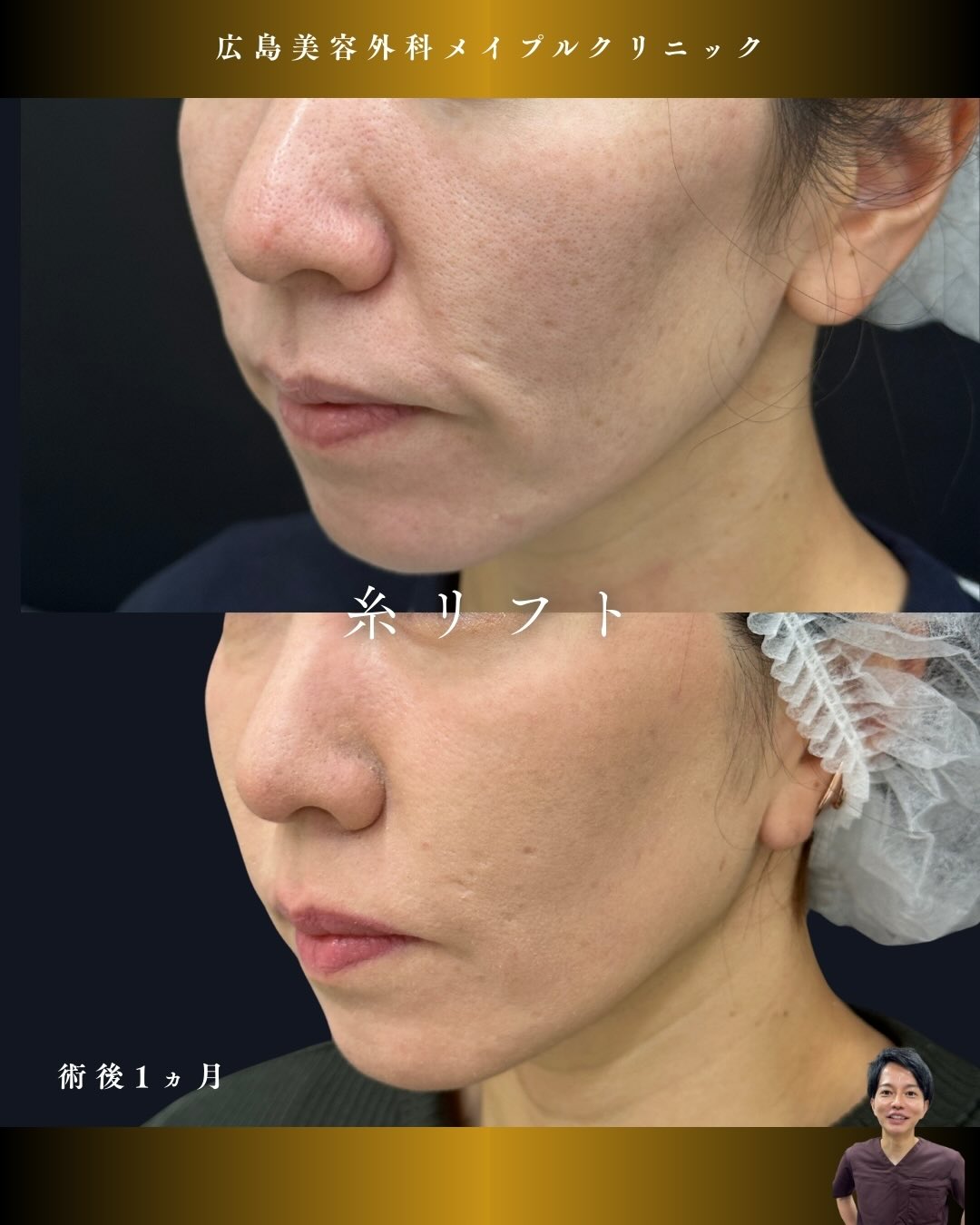 糸リフトとほうれい線へヒアルロン酸のメイン画像